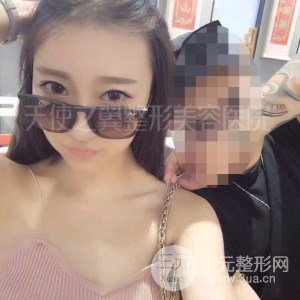 自體脂肪面部填充+全鼻金雕真實案例，恢復(fù)照片分享~