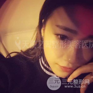 自體脂肪面部填充+全鼻金雕真實案例，恢復(fù)照片分享~