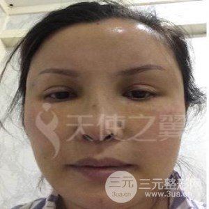 隆鼻整形修復(fù)+自體脂肪詳細(xì)部填充案例分享~