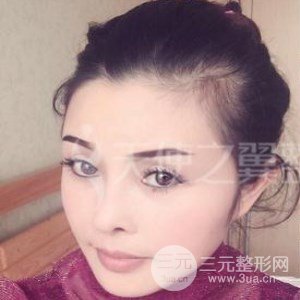 隆鼻整形修復(fù)+自體脂肪詳細(xì)部填充案例分享~