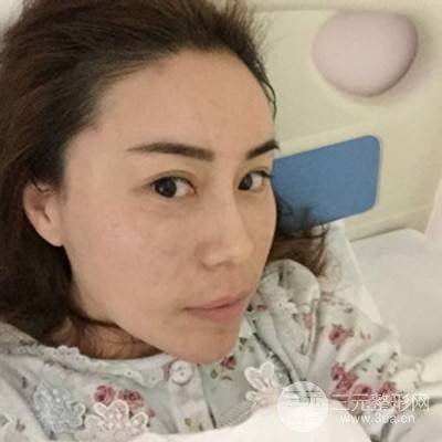 武漢美侖陳遠(yuǎn)海自體脂肪填充全臉案例，附上前后對(duì)比圖片