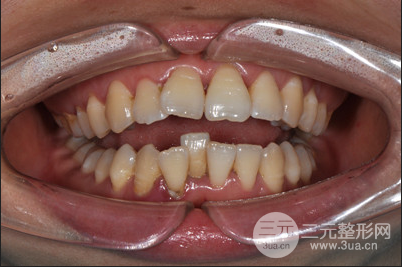 昆明醫(yī)科大學(xué)附屬口腔醫(yī)院黎明牙齒矯正果分享