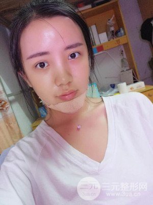 自體脂肪填充額頭+豐下巴真實案例，昆明都市儷人金海坤醫(yī)生做的