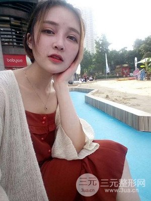 切開雙眼皮+假體隆鼻案例，前后對比圖分享