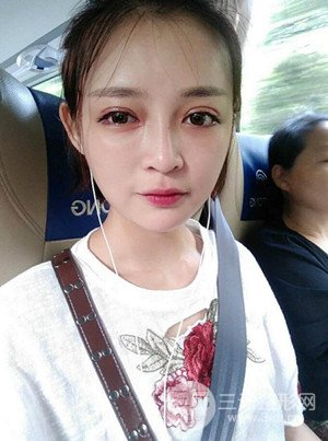 切開雙眼皮+假體隆鼻案例，前后對比圖分享