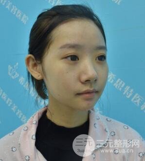 武漢希思特楊權(quán)明假體隆鼻案例日記真實記錄分享