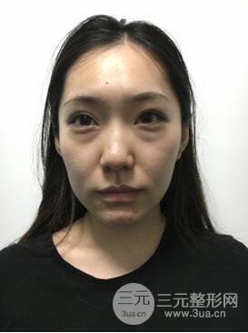 上海百*麗別箏隆鼻隆鼻整形案例果圖片日記分享