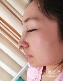 上海百*麗別箏隆鼻隆鼻整形案例果圖片日記分享