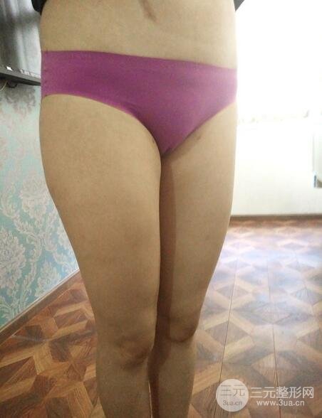 大腿抽脂后的恢復(fù)過(guò)程，真人案例真實(shí)分享