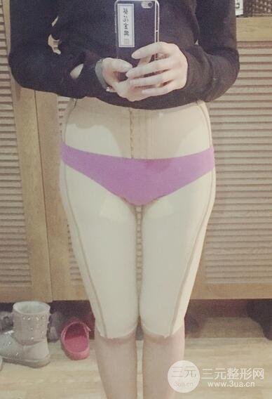 大腿抽脂后的恢復(fù)過(guò)程，真人案例真實(shí)分享