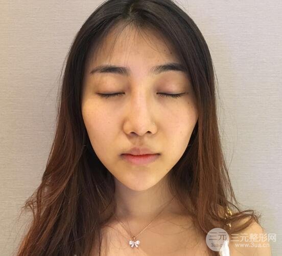 隆鼻整形術(shù)后1-7天的照片，前后對比果圖分享