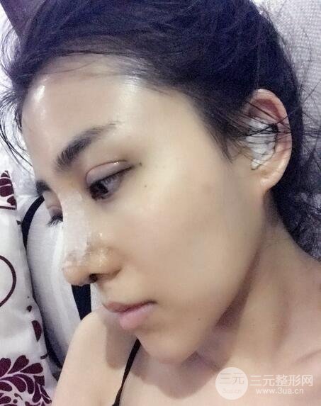 隆鼻整形術(shù)后1-7天的照片，前后對比果圖分享