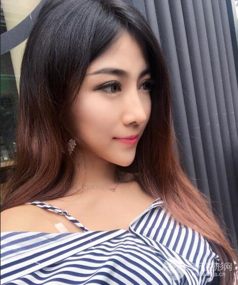 隆鼻整形術(shù)后1-7天的照片，前后對比果圖分享