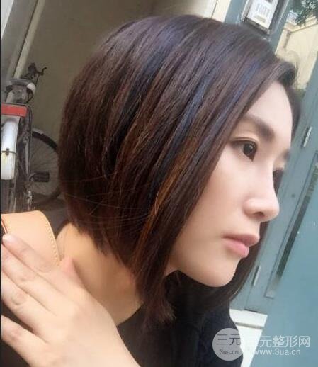 打完鼻子恢復(fù)的過程圖，隆鼻案例日記分享