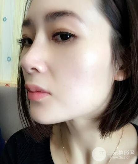 打完鼻子恢復(fù)的過程圖，隆鼻案例日記分享