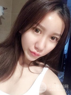 上海原辰自體脂肪填充案例，附上恢復(fù)過程以及對比圖片