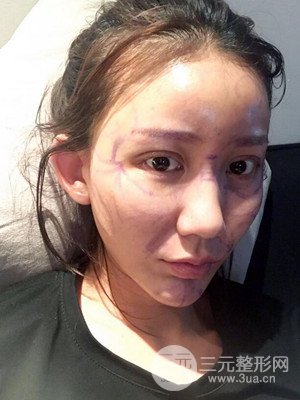 上海原辰自體脂肪填充案例，附上恢復(fù)過程以及對比圖片