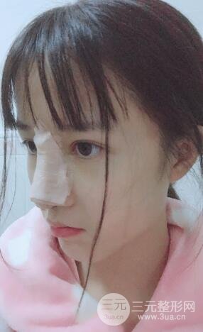 柏麗李勁良假體隆鼻案例果分享！小巧精致又立體~