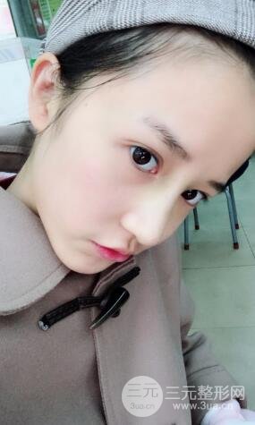 柏麗李勁良假體隆鼻案例果分享！小巧精致又立體~