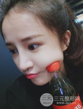 柏麗李勁良假體隆鼻案例果分享！小巧精致又立體~