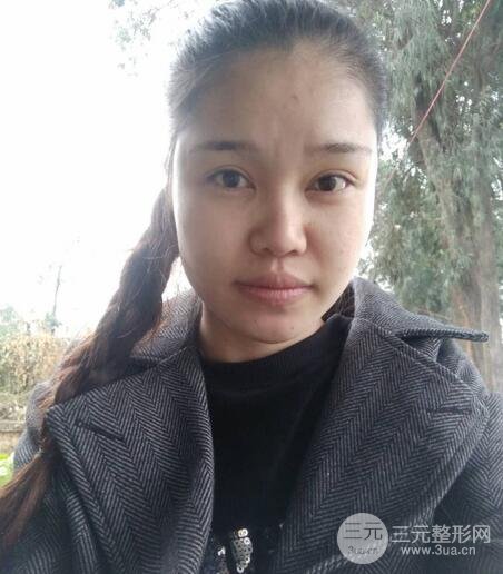 鼻頭縮小術(shù)過程圖，鼻頭縮小恢復(fù)日記