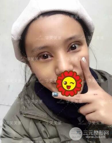 昆明華美楊繼紅全切雙眼皮怎么樣？真實案例圖片分享~