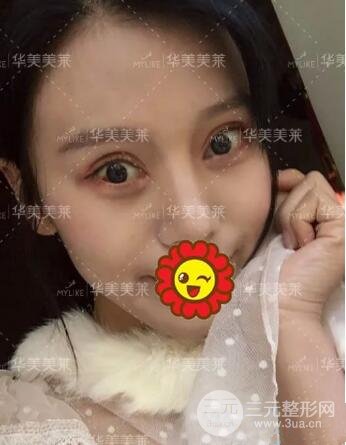 昆明華美楊繼紅全切雙眼皮怎么樣？真實案例圖片分享~