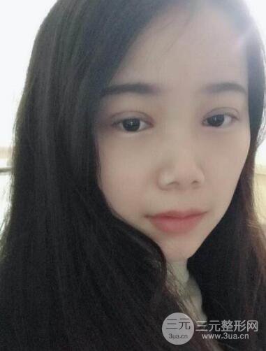 湘雅龍劍虹雙眼皮案例恢復(fù)日記分享