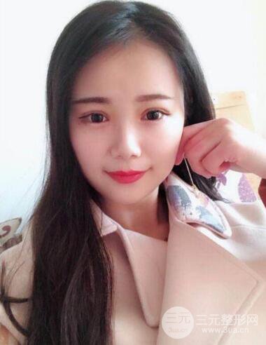 湘雅龍劍虹雙眼皮案例恢復(fù)日記分享