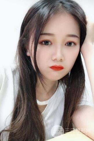 湘雅龍劍虹雙眼皮案例恢復(fù)日記分享