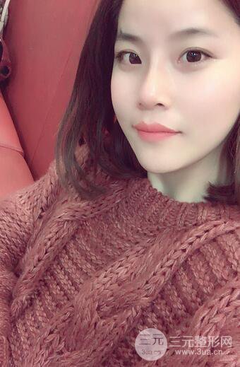 隆鼻鼻翼縮小全過程和術后照片分享，隨意揉捏很OK