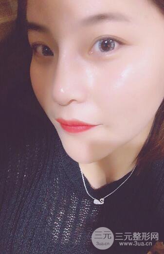 隆鼻鼻翼縮小全過程和術后照片分享，隨意揉捏很OK