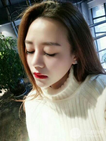 【高強度聚焦超聲面b提升術(shù)后照片】原來我的青春并沒有走遠~