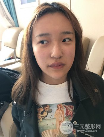 上海面部脂肪填充一個月果超明X、妥妥減齡十歲！