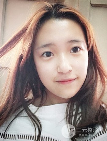 上海面部脂肪填充一個月果超明X、妥妥減齡十歲！