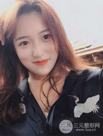 上海面部脂肪填充一個月果超明X、妥妥減齡十歲！