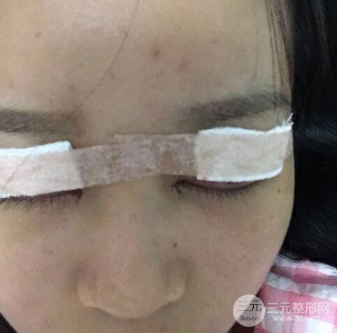 芭比電雙眼皮多項(xiàng)整形術(shù)后分享，雙眼皮拯救死魚眼！