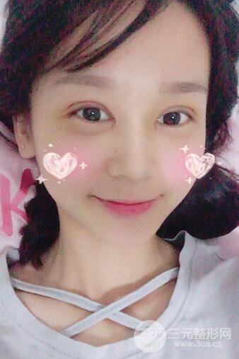 芭比電雙眼皮多項(xiàng)整形術(shù)后分享，雙眼皮拯救死魚眼！