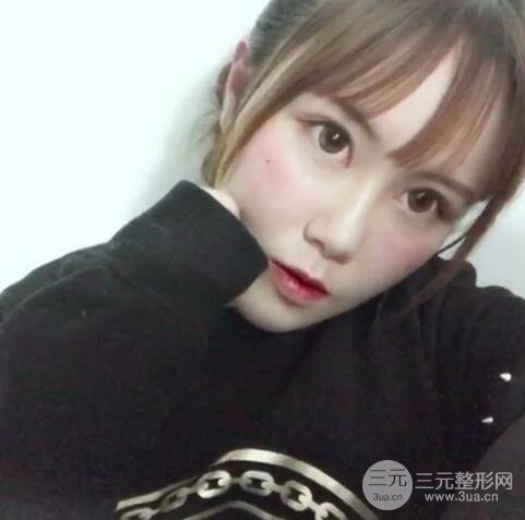 自體脂肪填充全臉基本換臉，改臉型不只是磨骨才能做到！