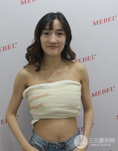 蘇州美貝爾假體隆胸案例，對比圖恢復(fù)過程分享~