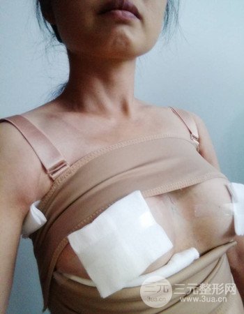上海假體隆胸真人案例，罩杯從A-到C不是夢