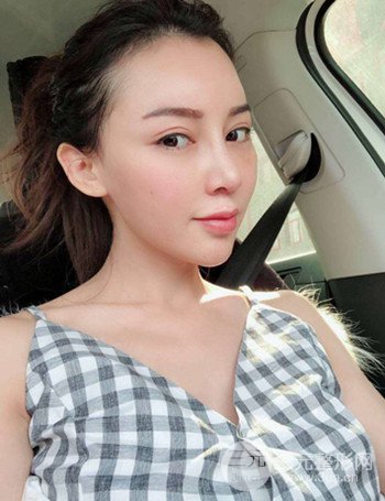 上海隆鼻失敗手術(shù)修復(fù)果超乎想象、前后對(duì)比照片分享