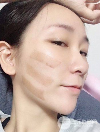 面部埋埋蛋白線.提升改良皮膚松弛，立現(xiàn)小V臉