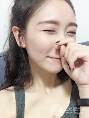 面部埋埋蛋白線.提升改良皮膚松弛，立現(xiàn)小V臉