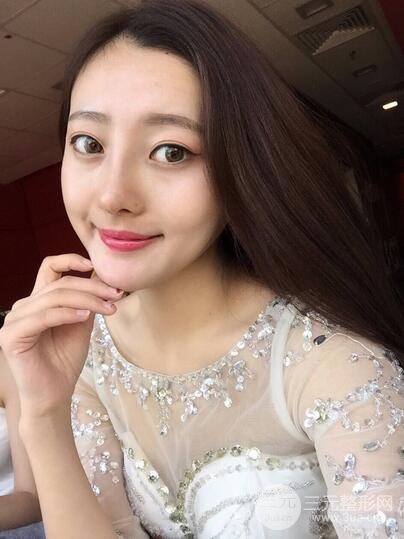 【肋軟骨隆鼻+歪鼻矯正案例】降低風(fēng)險無排異，可隨意揉捏