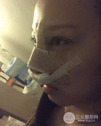 武漢美侖陳遠(yuǎn)海假體隆鼻案例，恢復(fù)過(guò)程分享~