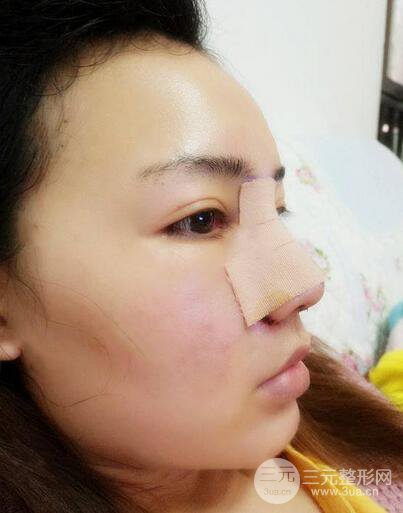 耳軟骨隆鼻全過程及術(shù)后果分享，親身體驗~