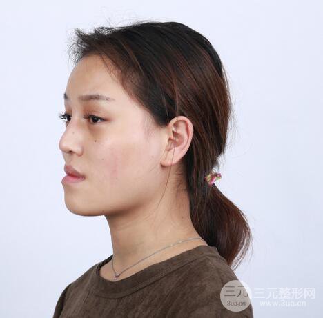 【下頜角+顴骨+下巴】全臉磨骨整形，術(shù)后的我人生開掛了！