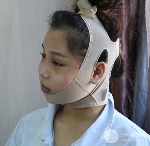 【下頜角+顴骨+下巴】全臉磨骨整形，術(shù)后的我人生開掛了！