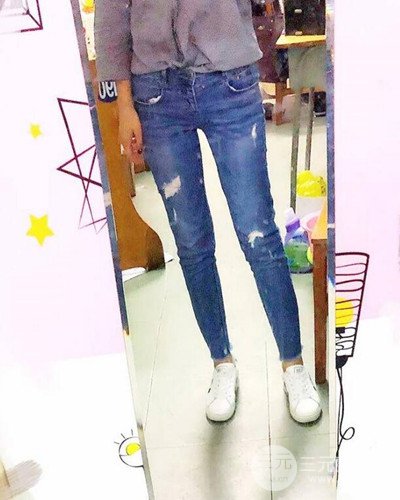 廣州韓妃大腿吸脂案例，恢復(fù)過(guò)程前后對(duì)比圖片分享~